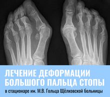 Лечение деформации большого пальца стопы в стационаре им. М.В. Гольца Щёлковской больницы