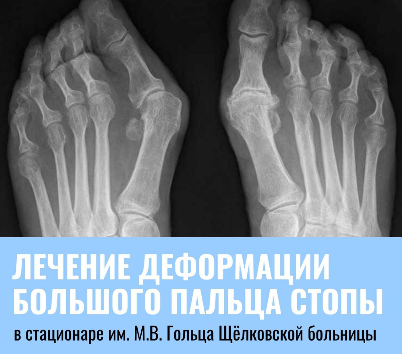 Лечение деформации большого пальца стопы в стационаре им. М.В. Гольца Щёлковской больницы