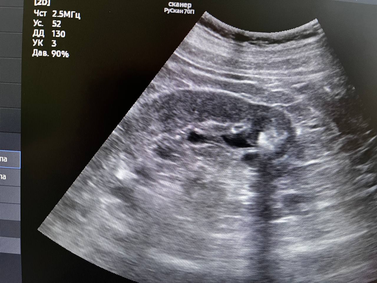 В прошедшую субботу в г. Фрязино в рамках дня открытых дверей, посвящённому здоровым почкам, пришли обследоваться 22 человека